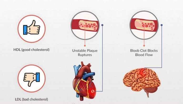 Connection Between Diabetes And Cholesterol